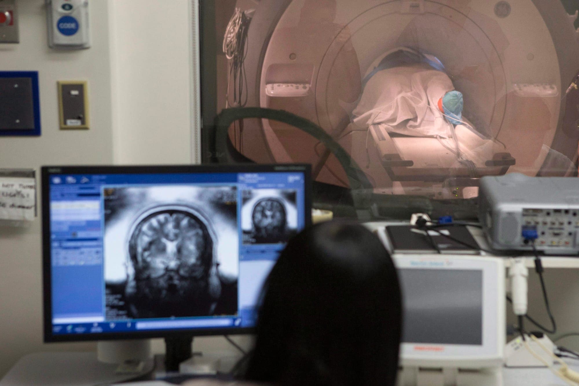 An image of Sky Zazlov's brain is displayed on a monitor screen as she lies in a MRI machine for a focused ultrasound procedure, at Toronto's Sunnybrook Hospital.